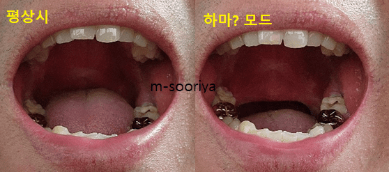 수면무호흡과 코골이 수술 후 1년 간의 효과, 부작용 및 솔직한 후기와 조언 안내
