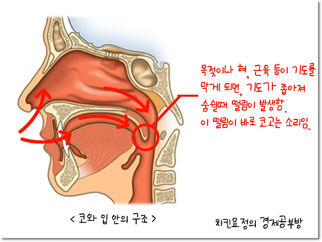 코골이 수술 6일차 통증, 회복 과정, 비용 및 재발로 인한 부작용 경험담 총정리
