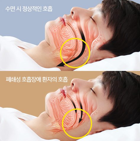 코골이 수술 후기: 20일에서 21일간의 통증과 회복 과정, 비용 및 재발 위험에 대한 솔직한 이야기