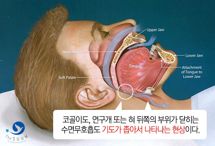 수면무호흡과 코골이 수술 5일차 회복기, 통증과 재발, 부작용 및 비용에 대한 모든 정보