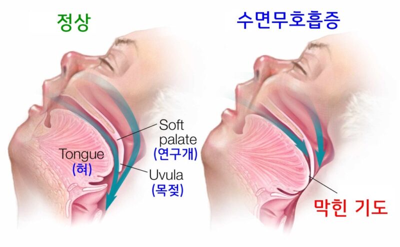 코골이 수술 후 회복기와 통증 관리, 비용, 재발 및 부작용 완벽 가이드